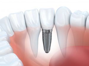 Dental Implants Philadelphia PA
