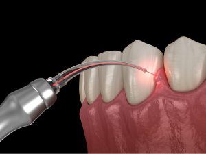 Laser Gum Therapy Philadelphia