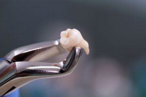 Wisdom Teeth Removal in Philadelphia, PA