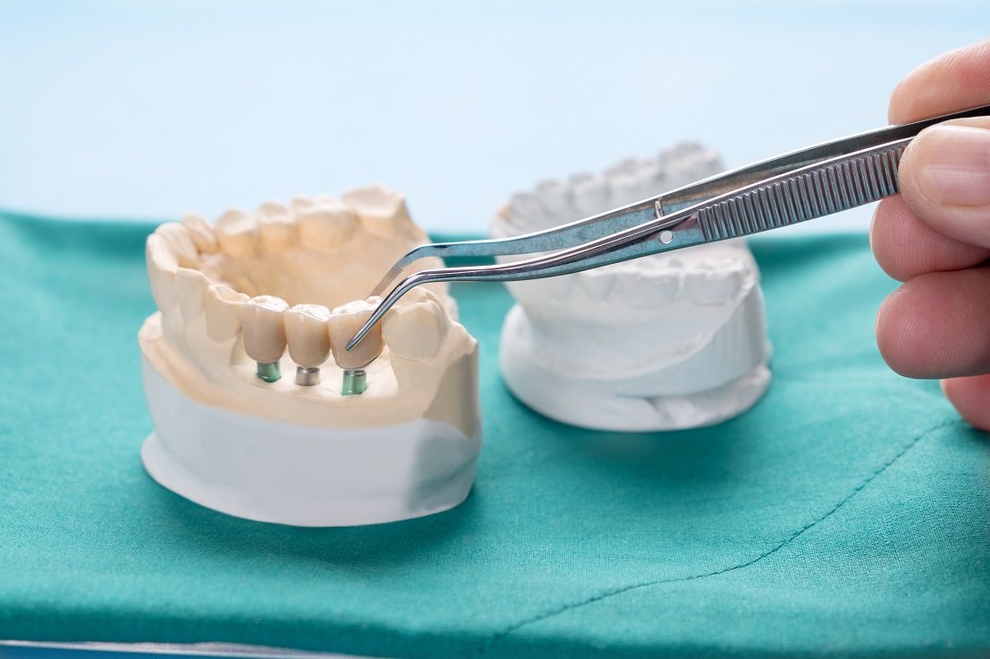 Implant Supported Bridges Philadelphia PA